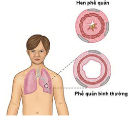Hen phế quản