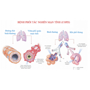 Bệnh phổi tắc nghẽn mạn tính