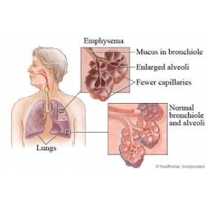 Các bệnh đồng mắc COPD