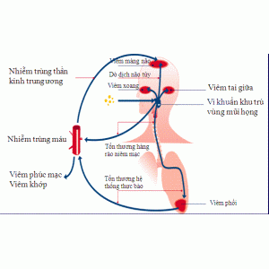 Tiêm ngừa phế cầu