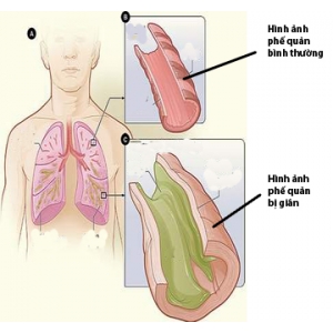 Ho có đờm kéo dài có thể là dãn phế quản