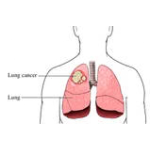 Tổng quan về ung thư phế quản 