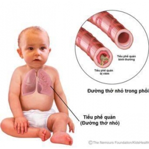 Viêm tiểu phế quản