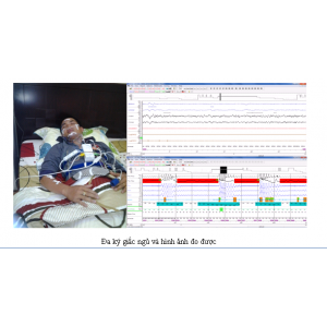 Berlin Questionnaire to perform Sleep Apnea screening