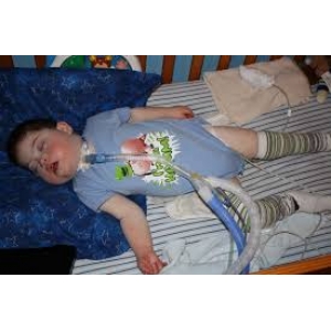 Sleep apnea in children
