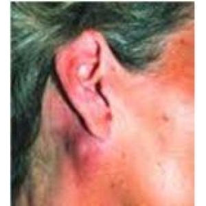 Lao hạch