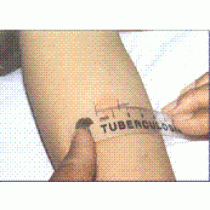 Phản ứng lao tố TST